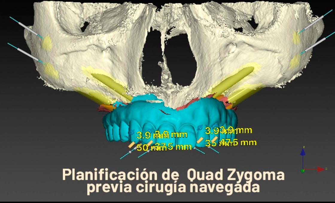 El Dr. Rubén Davó lidera un estudio que avala el Quad Zygoma como rescate para implantes fallidos